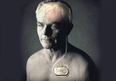 起搏器真的能治好帕金森病嗎？